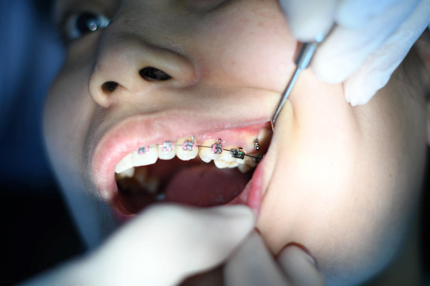 A dentist examining a patient's teeth

Description automatically generated with medium confidence