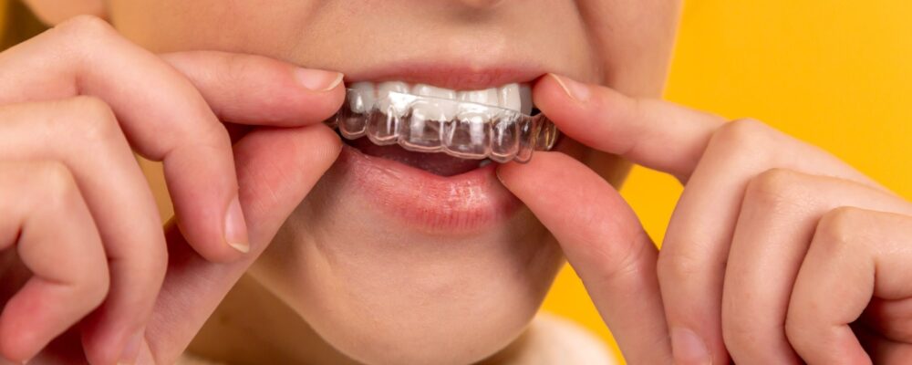 The Inman aligner and how it works