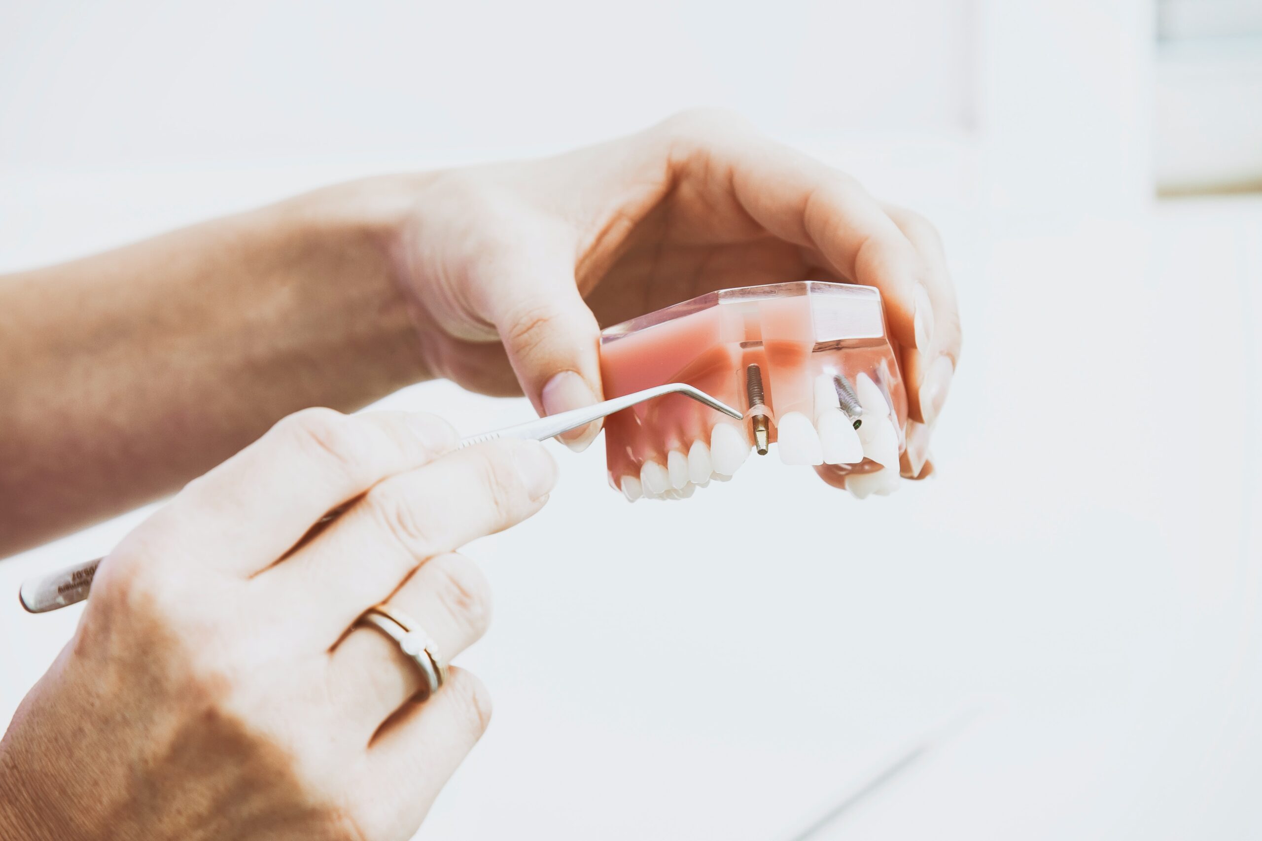 Dental implants vs dentures – what’s best for me?