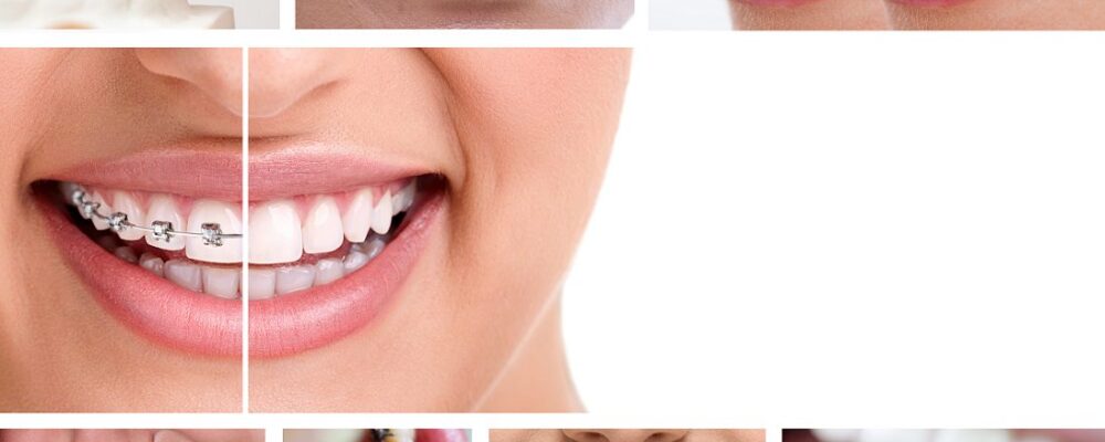 Taking Care Of Oral Health When Wearing Braces